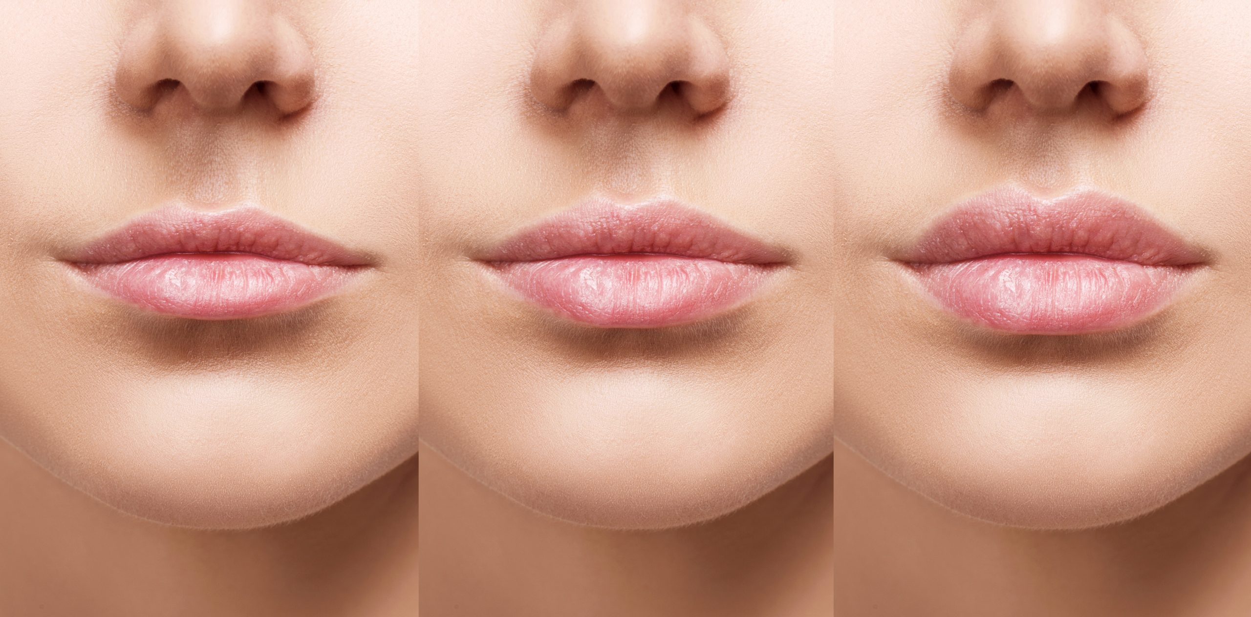 lip fillers